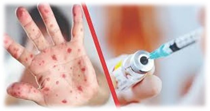 Корь - информация о заболевании